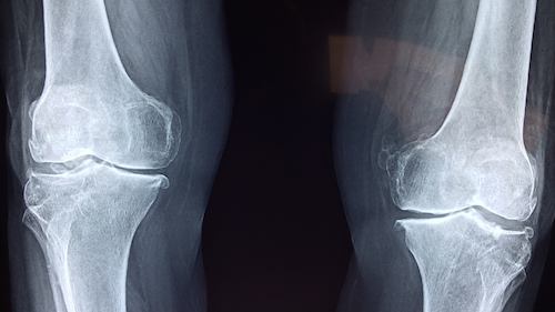 Strength Training for stronger bones & reducing Osteoporosis